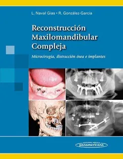 Portada de Reconstrucción maxilomandibular compleja: microcirugía, distracción ósea e implantes